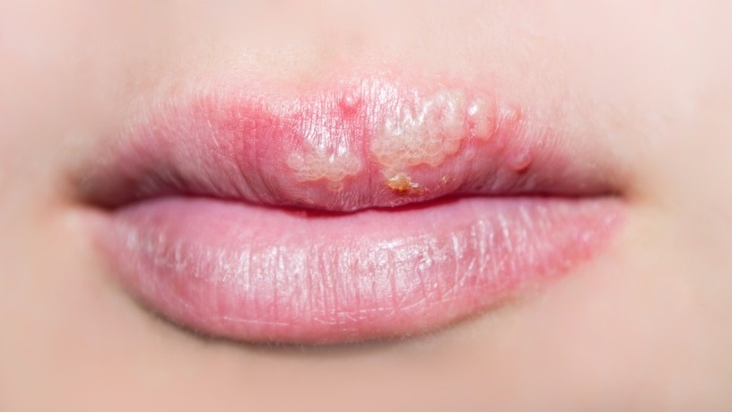 ajakherpesz, herpeszvírusok, herpes simplex, HSV-1, vírus, tünete, kezelése