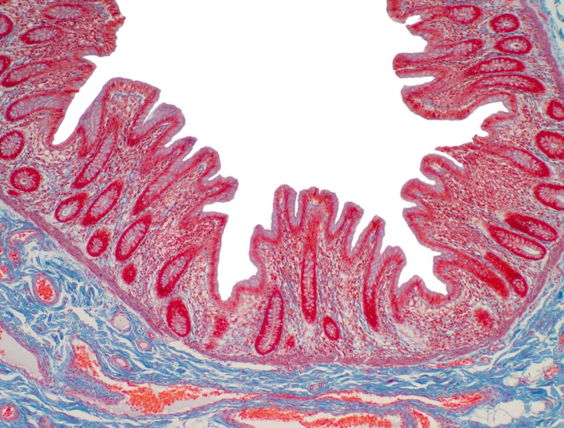 fekélyes vastagbélgyulladás típusa Mikroszkópos colitis