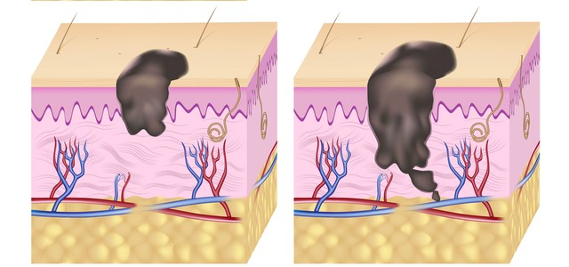 Kamerával szúrja ki a bőrrák korai tüneteit ez a mesterséges intelligencia