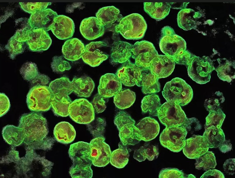 amőba agyhalál orrmosás texas