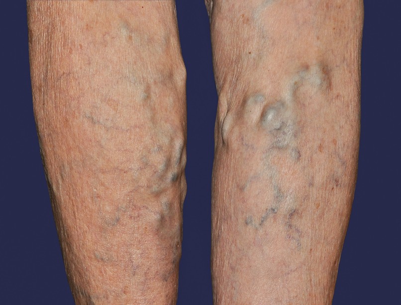 visszér kanyargós felületi trombózis