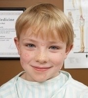 Hogyan öröklődik az allergia?