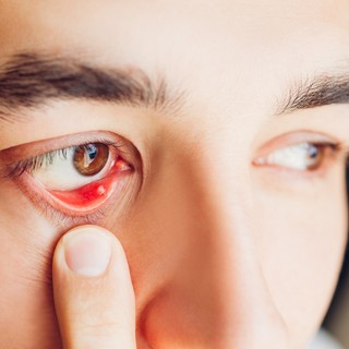 Árpa a szemen: ilyen tünetek mellett mindenképp forduljon orvoshoz! című cikk nyitóképe