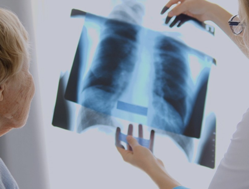  tüdőfibriózis, tüdőbetegség, köhögés, SSc-ILD, 