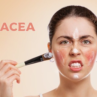 Rosacea: okai, tünetei és kezelése című cikk nyitóképe