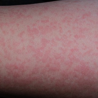 Lepkehimlő tünetei gyerekeknél című cikk nyitóképe