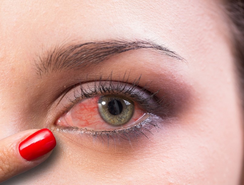 viszkető, szúró, szem, kötőhártya-gyulladás tünet, kezelés