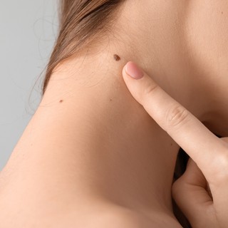 Honnan tudható, ha kóros az anyajegyen talált elváltozás? Bőrgyógyász mondja el című cikk nyitóképe