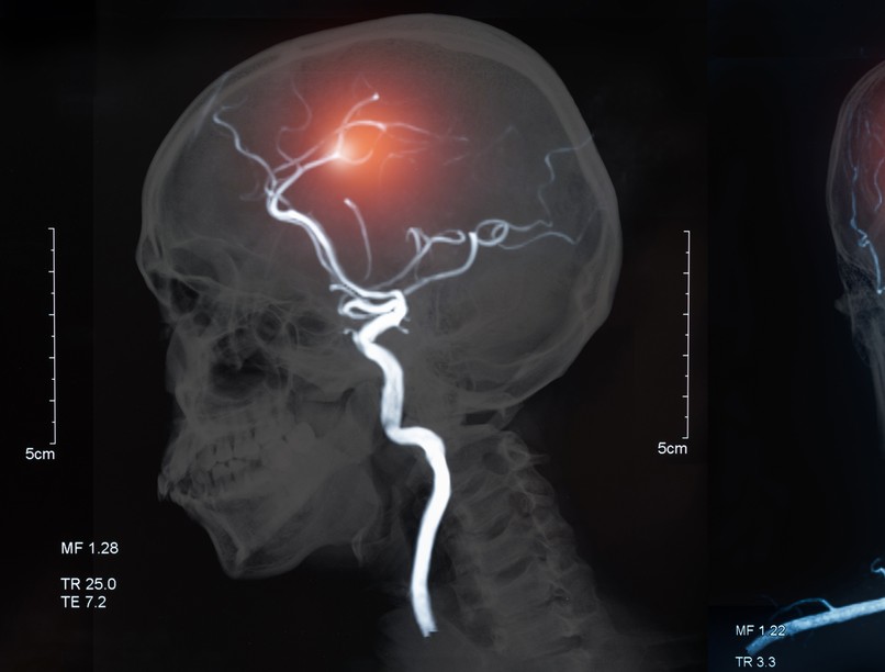 stroke, rehabilitáció, agyi infarktus, beszédzavar, halálozás