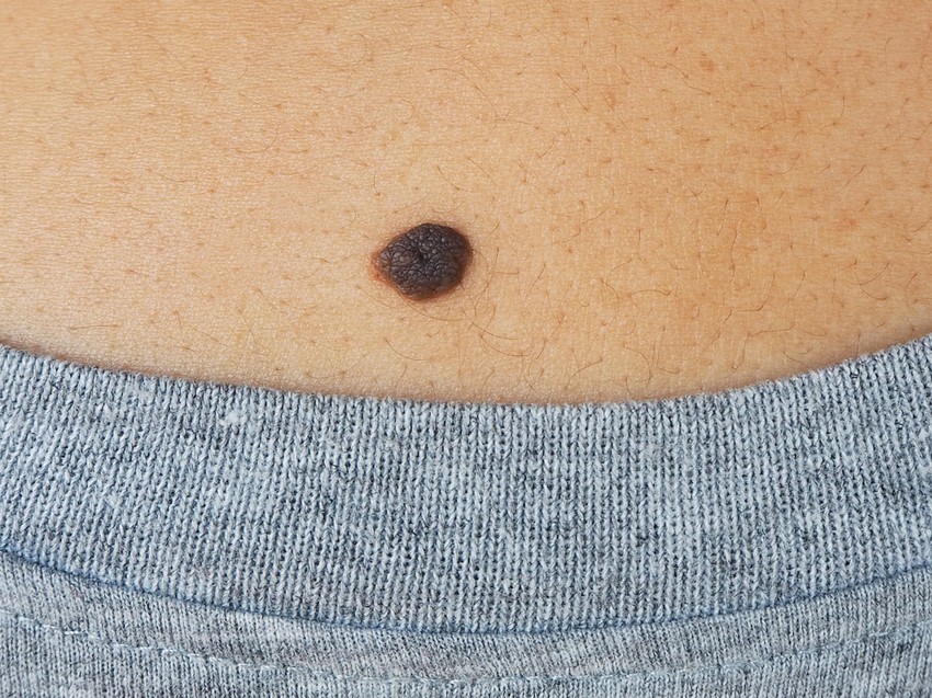 A noduláris melanoma a melanomák legagresszívebb típusa, amely gyorsan terjed, és gyakran csak az utolsó pillanatban diagnosztizálják.