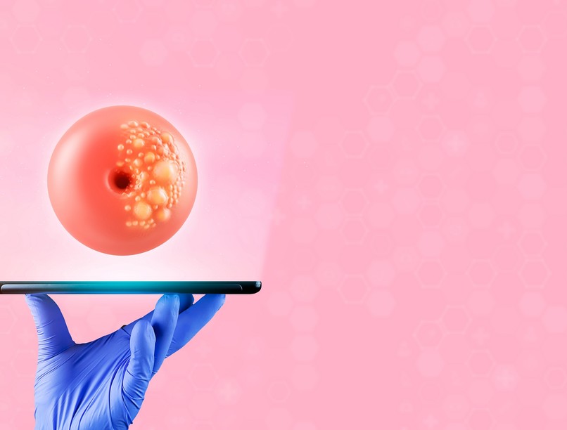 milyen gyorsan alakul ki méhnyakrák korai stádium tünet