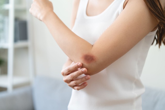 Az orvos szerint ez az apró változás a bőrön halálos vérrákot is jelezhet című cikk nyitóképe