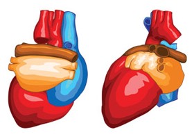 Három sikeres szívátültetés 24 óra alatt Magyarországon