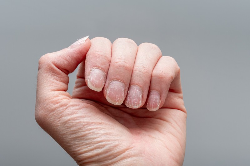 Mit árulnak el a körmeink az egészségünkről? 7 aggasztó jel, amire jobb felfigyelni