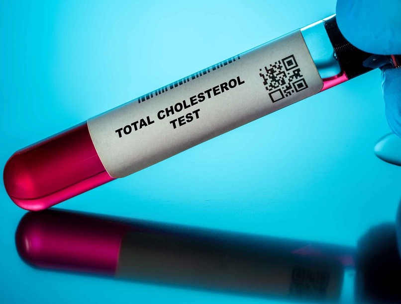 Mit jelent összkoleszterin érték laborlelet