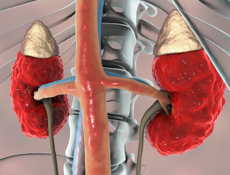 Akut veseelégtelenség tünet vizsgálat kezelés