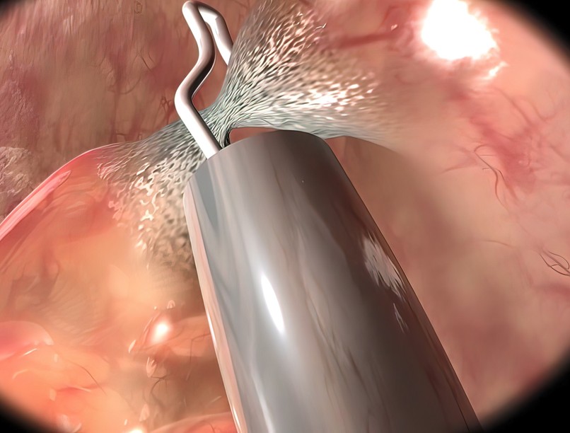 vastagbélpolip méhpolip rosszindulatú daganat