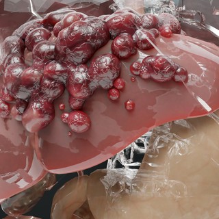 Alkoholos májkárosodás: tünetei, vizsgálata és kezelési lehetőségei című cikk nyitóképe