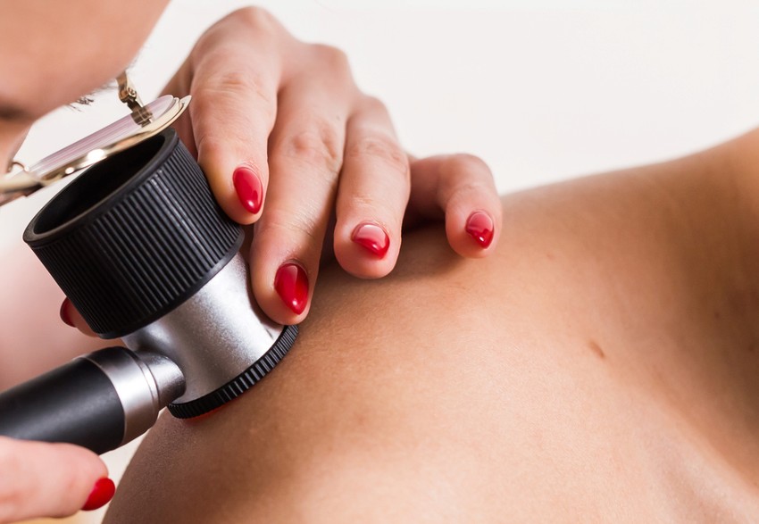 A melanoma az önellenőrzés során nehezen látható és hozzáférhető testrészeken is kialakulhat.A melanoma anyajegyek formájában, méretében és színében eltéréseket okoz, de a bőrön újonnan jelentkező elváltozás formájában is kialakulhat.