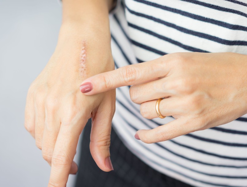 heg, hegesedés, bőr, plasztika