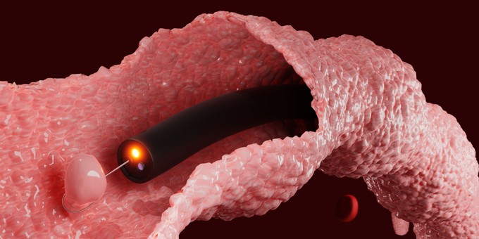 Ekkor érdemes kolonoszkópiára menni még 50 éves kor előtt - még akkor is, ha nincsenek tünetei című cikk nyitóképe