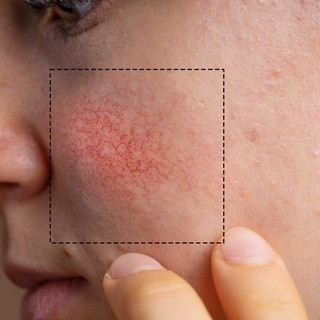Rosacea - ezekre figyeljen a nyáron, hogy ne lobbanjanak be a tünetek című cikk nyitóképe