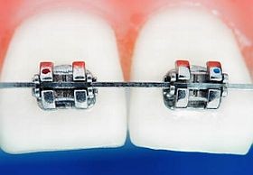 Fogszabályozókon nyüzsgő mikrobák...