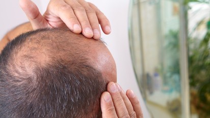 Egy hajszálnyira a siker: a tudósok végre megtalálták a kopaszság lehetséges ellenszerét című cikk nyitóképe