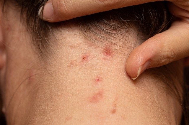 Kanyaró: tünetei, vizsgálata és a kezelési lehetőségei