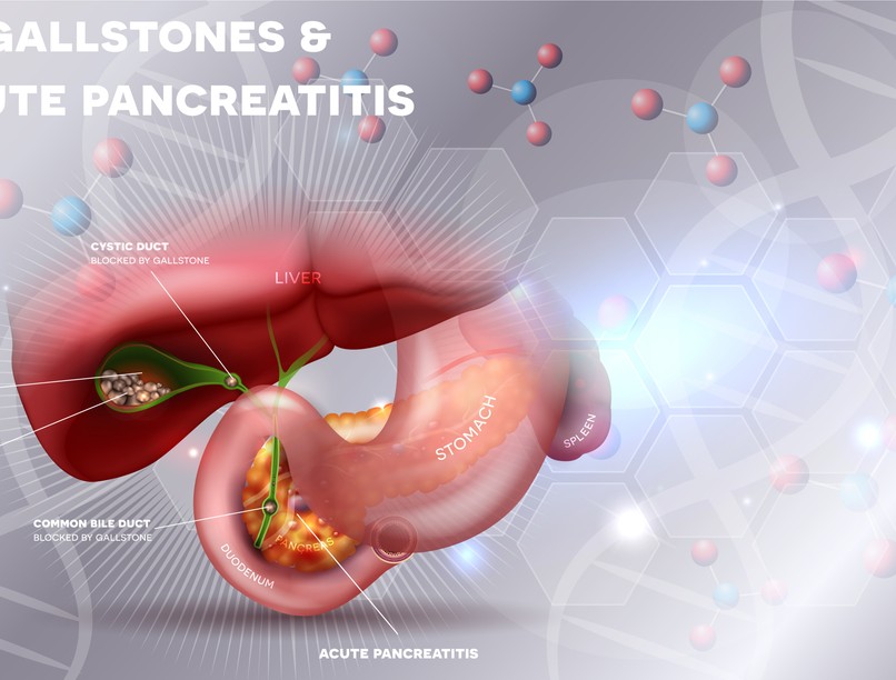  Epekő, oka, tünetei, kezelése, Epekövesség, Epegörcs, Görcsoldó,
