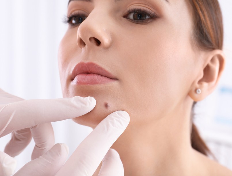 anyejegy, szemölcs, eltávolítás, kimetszés, érzéstelenítés, bőrdaganat 