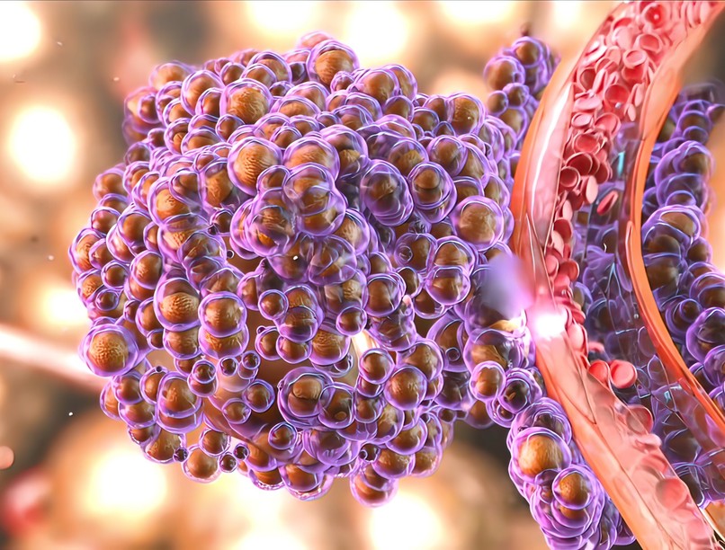 kiujulo, rák, tumor daganat oka