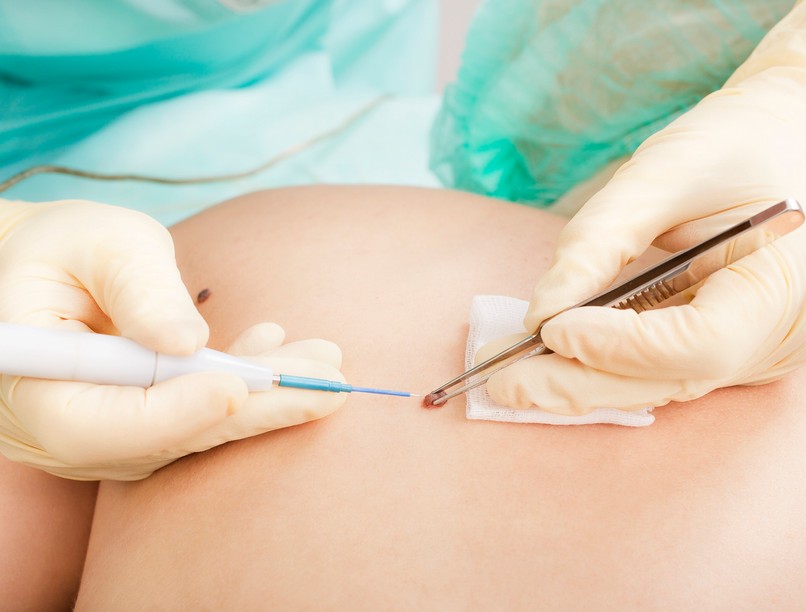 anyajegy eltávolítás mire számít