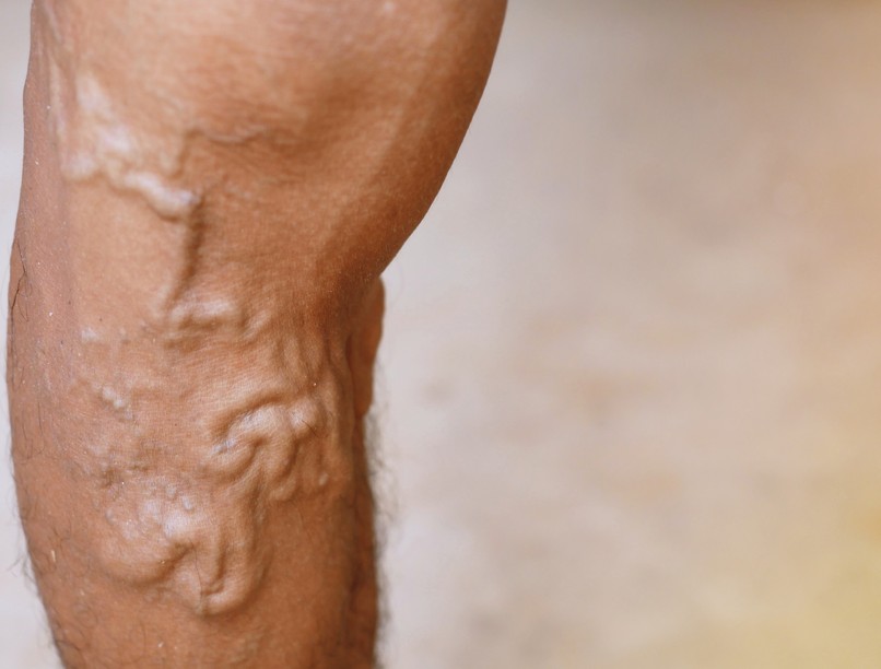 Genetikai hajlam trombózis rizikó