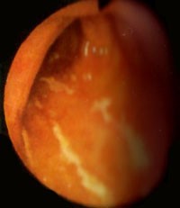 Meghívó a Gyermekrák Alapítványtól