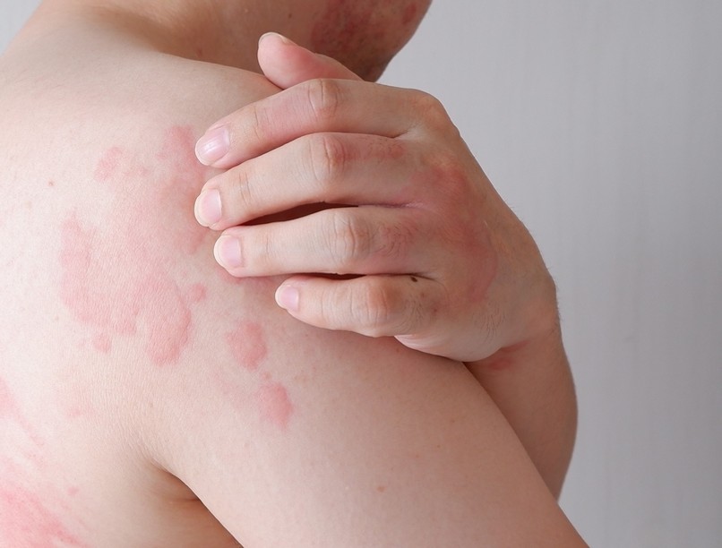 hisztamin intolerancia, hisztamin intolerancia tünetei, hisztamin intolerancia kezelése, HIT, DAO