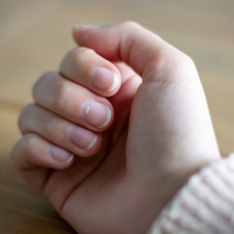 Tényleg vitaminhiányt jeleznek a körmön megjelenő fehér foltok? című cikk nyitóképe