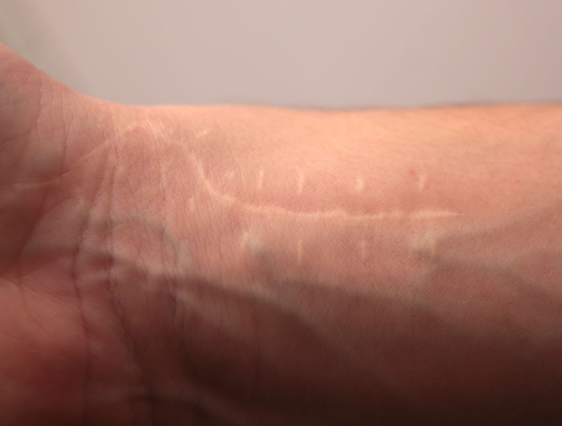 műtéti beavatkozás hegesedés hegkezelés hogyan