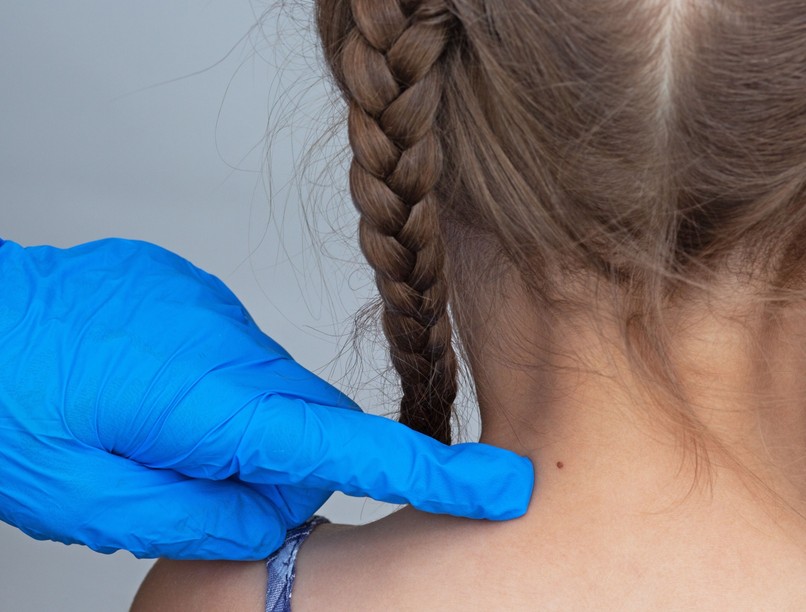 Az erős napsütés előhozhat új anyajegyeket? Az orvos válaszol