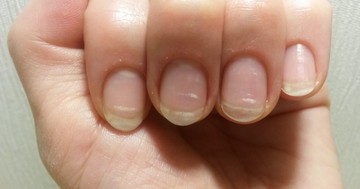  Barázdák, foltok, mélyedések, csíkok a körmön - melyik, milyen problémát jelez? 