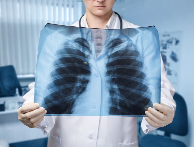 okozhat rákot a röntgen orvos válaszol