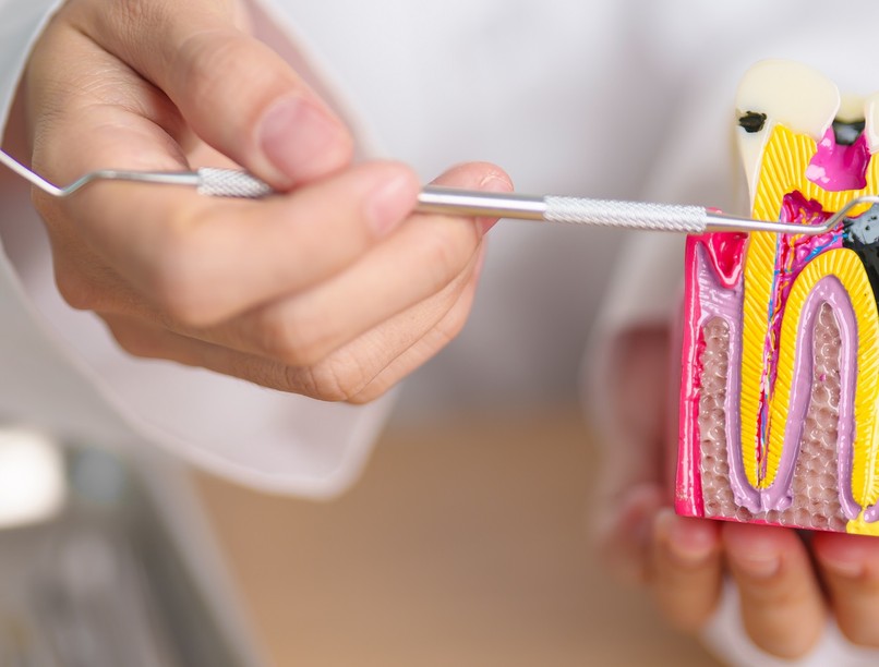 fogszuvasodás, fogászati problémák