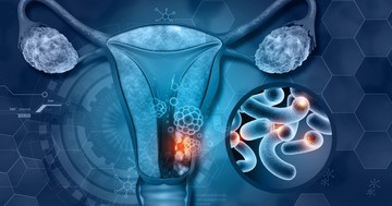 Hogyan alakul ki a szervezetben a gyulldás, és milyen szerepet játszanak benne a petefészkek menopauza után?