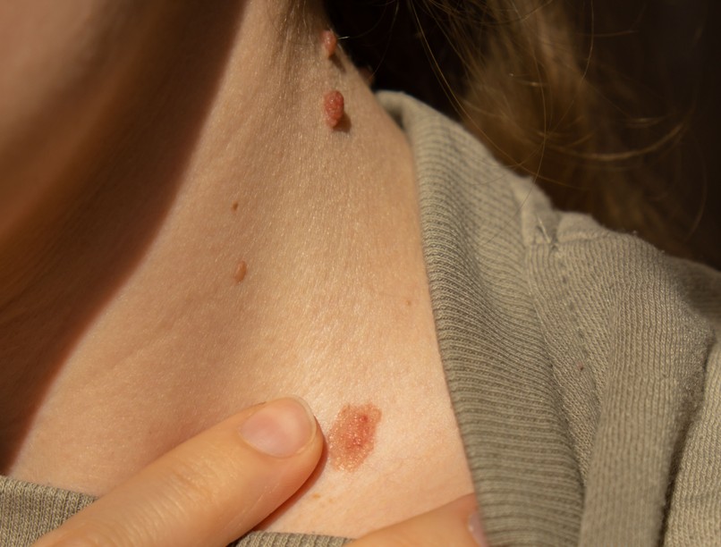 bőrdaganat bőrrák felismerése ABCDE-módszer