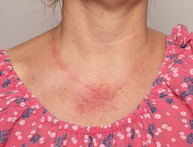 bőrpír erythema tünet bőrtünet