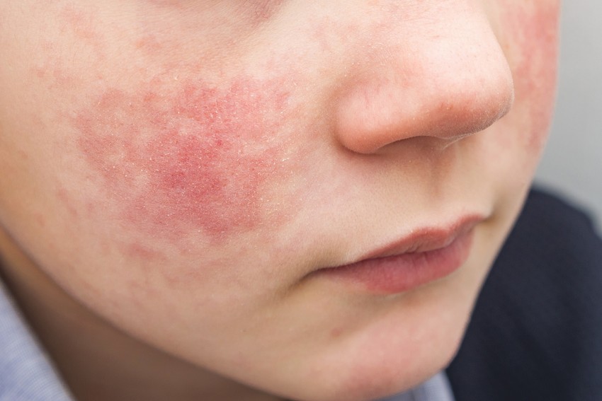 A lepkehimlő, orvosi nevén erythema infectiosum, egy vírusos fertőzés, amelyet az emberi parvovírus B19 okoz. A vírus általában iskoláskorú gyermekeket fertőz (5-15 év), de felnőttek is megbetegedhetnek. A vírussal való találkozást követő 5-10 naptól kezdve fertőznek a betegek, mely körülbelül 5 napig tart.