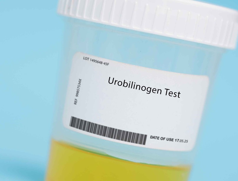 Mit jelent urobilinogén UBG érték laborlelet