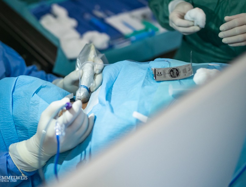 pajzsmirigy megnagyobbodás termoabláció kezelés