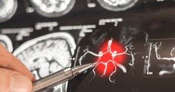 Forradalmi fordulat az Alzheimer-kutatásban: a K-vitamin új változata képes újjáépíteni az agysejteket