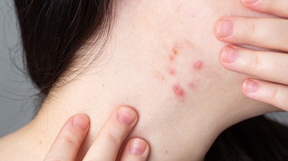 Pattanások a nyakon: nem véletlenül jelennek meg – ezt üzenheti a szervezete című cikk nyitóképe